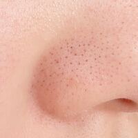 閲覧注意 鼻の毛穴の黒ずみがなくなる方法はありませんか 毛穴に効く Yahoo 知恵袋