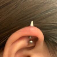 ピアスについてです この程度の肉芽はホットソークで治せますか Yahoo 知恵袋
