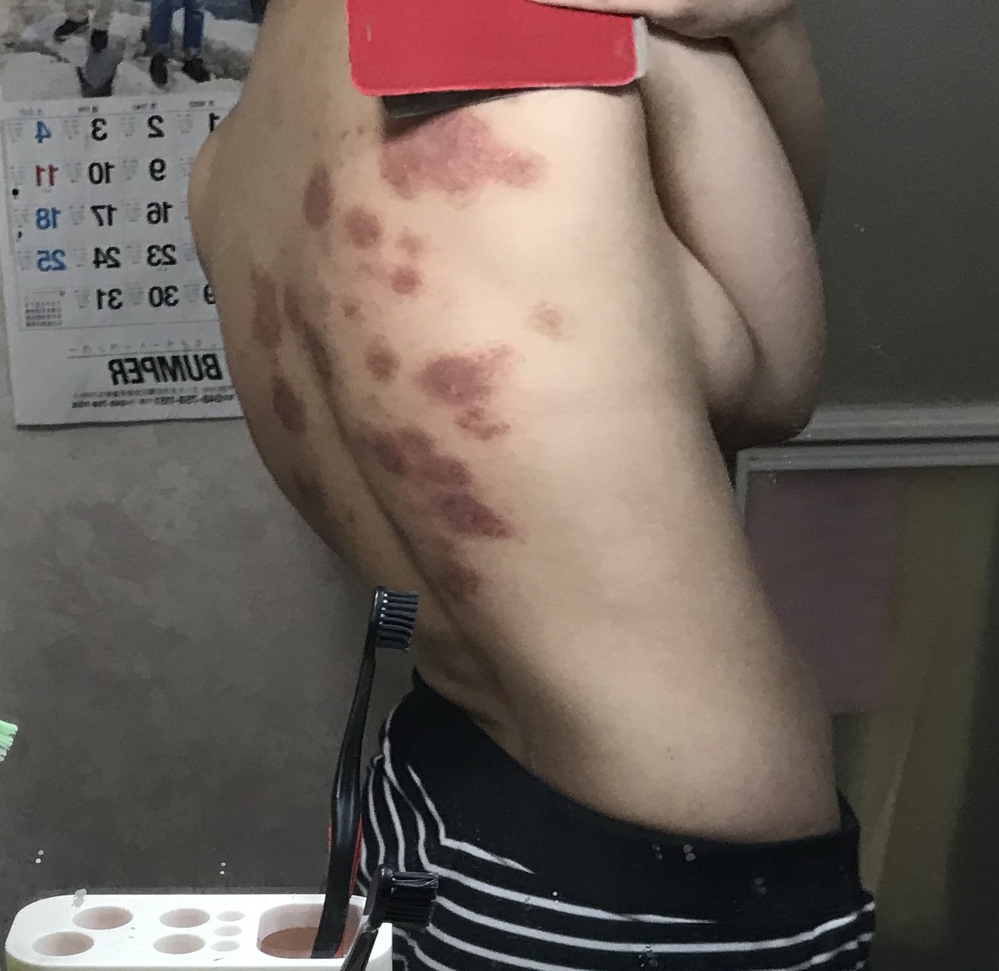 皮膚の病気 アトピー 解決済みの質問 Yahoo 知恵袋