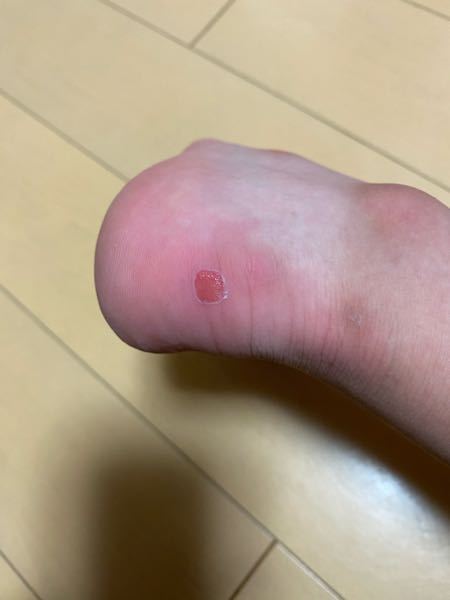 靴擦れして激痛なのですがこのままほっといても大丈夫でしょうか？また