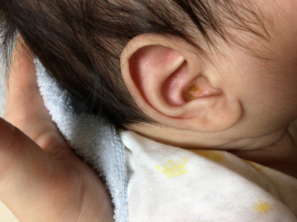 赤ちゃんの耳の入り口あたりに耳垢 がくっついていて 臭います 前にベ Yahoo 知恵袋