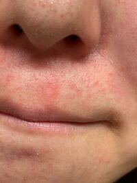 ベピオゲルについて使用約5ヶ月 ニキビ跡の治療で使用しているので Yahoo 知恵袋