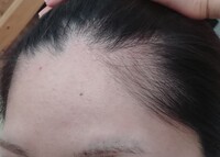 31歳 です 最近 抜け毛がひどく落ち込んでいます シャンプーすると軽く50本 Yahoo 知恵袋