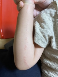 2才半の子供です 線状の湿疹が3ヶ月治りません 皮膚科には行きました Yahoo 知恵袋