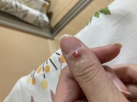 画像に患部載せてます 苦手な方は注意ささくれがむけて治りません 最初はささくれ Yahoo 知恵袋