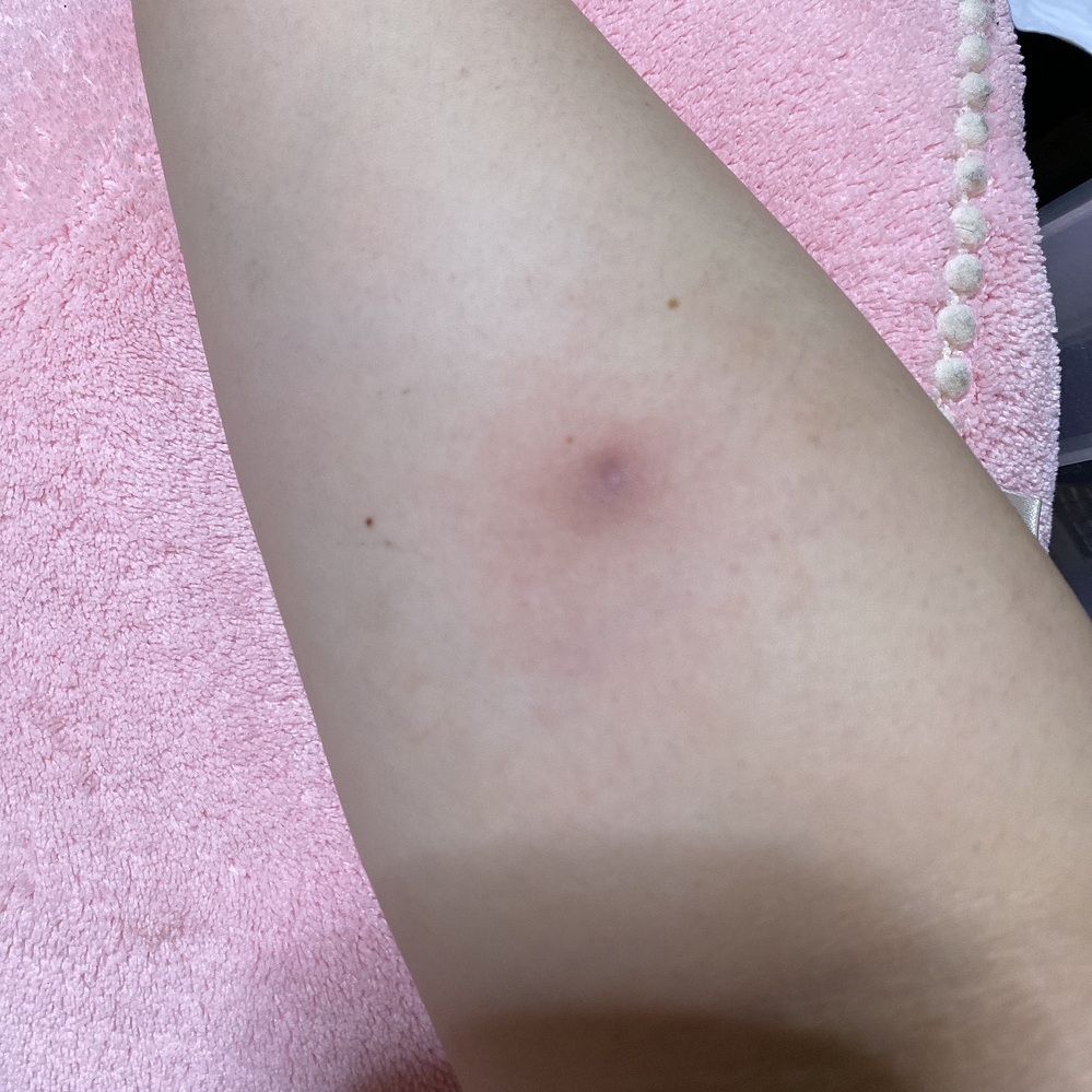 写真あり 2ヶ月ほど前から腕に変なしこり できもの ができました はじめは毛穴 Yahoo 知恵袋
