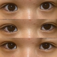 これは二重整形失敗ですよね 1枚目はガン開き2枚目は薄開き3枚目は普 Yahoo 知恵袋