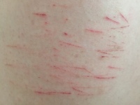 親にレグカ(レッグカット)がさっきバレました。※写真のは残り傷です。去年レグカとodやっててですが2ヶ月くらいで辞めました。 もう辞めたと思ったら最近嫌な事や怖いことが多すぎて逃げ道としてやってしまって再開し1週間でばれました。親にはこれ何って聞かれたからなんでもない引っ掻いたのったら違うでしょこれ切ったでしょ見たらわかるよバカじゃないの？自分傷つけて何になるわけ？憧れてやってんの？誰に影響...
