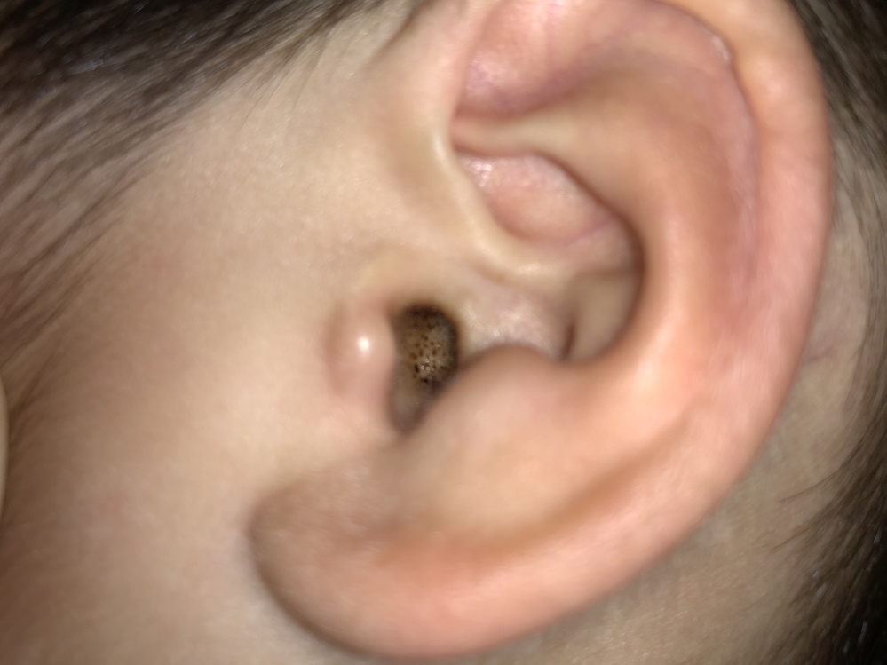 2歳の子供の耳の中が赤ちゃんの頃から汚いです 耳の中の毛穴 から黒い脂の Yahoo 知恵袋