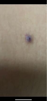 以前お腹にニキビができ それを放置していたら潰れていてそこから1か月くらい経っ Yahoo 知恵袋