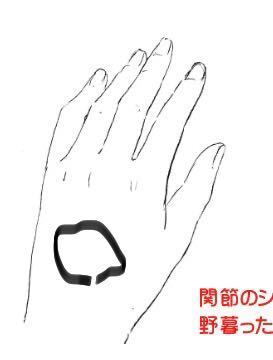 過食嘔吐の人に質問します 指吐きしてると歯が当たってここら辺に Yahoo 知恵袋