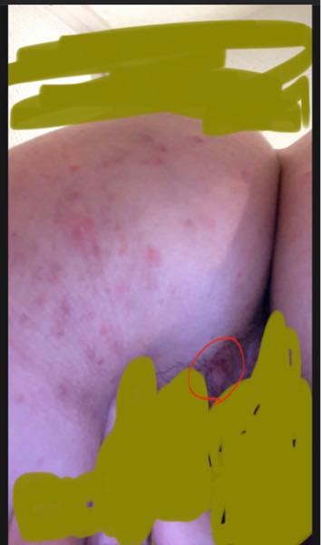 ニキビケア 回答受付中の質問 Yahoo 知恵袋