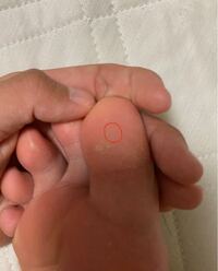 足の裏のしこり について質問です 2ヶ月ほど前から裸足で歩いて Yahoo 知恵袋