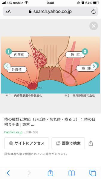 イボ痔 治し方 に関するq A Yahoo 知恵袋