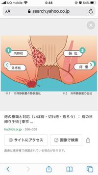 イボ痔の治し方がわかる人いますか 痛みがあります 肛門より外側 Yahoo 知恵袋