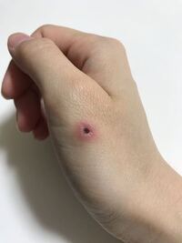 これなんでしょうか 日近く前に何かの虫に刺されました 自分 Yahoo 知恵袋