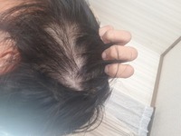 髪をめくると写真の通り地肌が白く見えるほど髪の密度が薄いのですが Yahoo 知恵袋