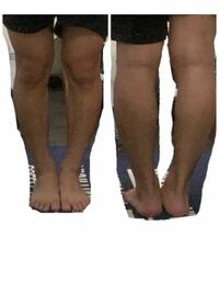O脚改善について ｏ脚について調べると治らないｏ脚と治るｏ脚と2種類あると Yahoo 知恵袋
