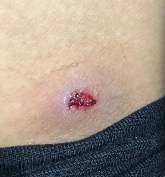 グロ注意写真あります これな何でしょうか 股の付け根に出来物が出来ました Yahoo 知恵袋