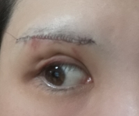 眉下切開をして18日経ちます ひきつれ線 みたいなのがでてきてしまって失敗され Yahoo 知恵袋