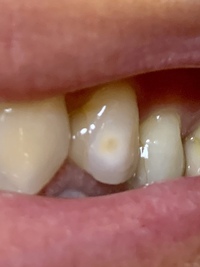 これは虫歯ですかね 汚い画像で申し訳ありません 歯の一部分が茶 Yahoo 知恵袋