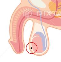 精巣上体炎 しこり