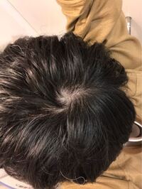 これはつむじハゲの前兆ですか Yahoo 知恵袋