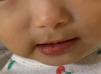 1歳半の赤ちゃんの唇に水疱ができてしまいました 特に痛がったりはしていな Yahoo 知恵袋