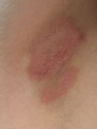 脇の下が痒いです 最近脇の下が赤くなっていてその部分が皮が剥け Yahoo 知恵袋