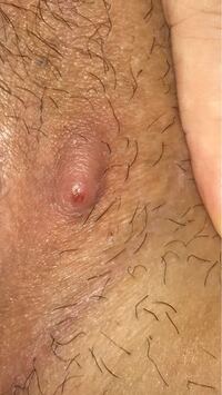 写真 陰部 Iライン におできができました 毛嚢炎でしょうか 少し潰し Yahoo 知恵袋