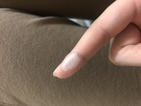 4日前に コテで火傷をしました 今は痛みなし 水ぶくれのように膨れてもいません Yahoo 知恵袋