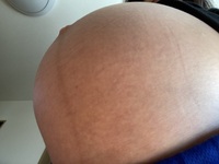 この画像は妊娠線もうありますか 正中線は違うとわかりますが なんというか皮膚の Yahoo 知恵袋