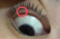 見づらいですが 写真のように目の縁に出来物が出来ました 痛くはなく Yahoo 知恵袋