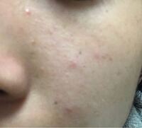 汚い写真すみません 高校2年女子ですマスクつけることでより荒れてます肌ス Yahoo 知恵袋