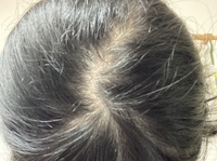 19歳女です ここ3年くらい抜け毛が酷いです 髪の毛を伸ばし始 Yahoo 知恵袋