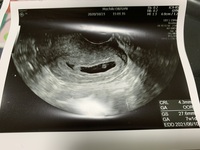 初めての妊娠です 今日 病院で99 流産だと言われました 8週目なのに心拍が確 Yahoo 知恵袋