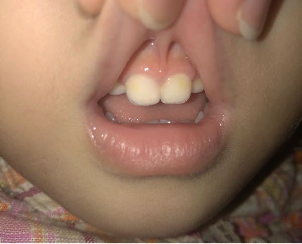 2歳7ヶ月の子供の上唇小帯です やたら下に 歯に近い所にくっつ Yahoo 知恵袋