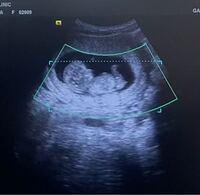 妊娠12週4日です ご覧頂いてありがとうございます このエコー Yahoo 知恵袋