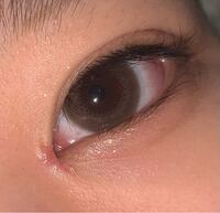 目頭切開後にしこりができて硬いです 施術はちょうど1か月前です 右目はここまで Yahoo 知恵袋