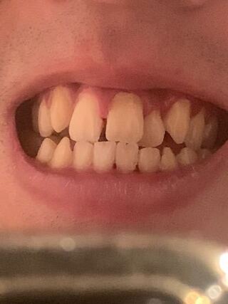 歯科 検診 虫歯 隠す 方法