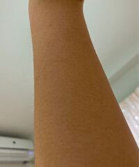 画像注意 腕と脚の毛穴が目立つのですが どうしたら治るでしょうか 乾 Yahoo 知恵袋