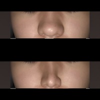 鼻クリップで鼻の形は変えられるのでしょうか 色々なサイトを沢 Yahoo 知恵袋