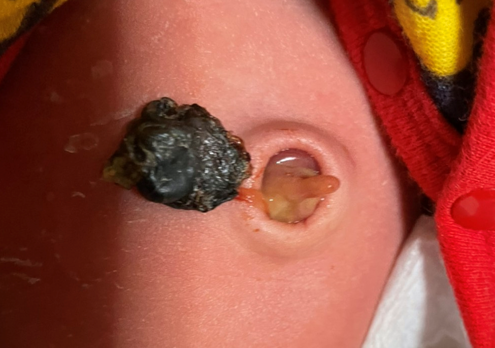 ジュクジュク へその緒 に関するq A Yahoo 知恵袋