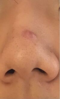 閲覧注意です 毛穴汚い鼻の画像があります 3日ほど前から鼻に大きなニ Yahoo 知恵袋