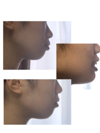 軽度のアデノイド顔貌の場合高校生でも鼻呼吸にするだけで改善されることはあり Yahoo 知恵袋