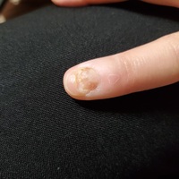 爪が根元から剥がれてしまいました 剥がれたときは赤く痛かったですが だいぶ薄皮 Yahoo 知恵袋