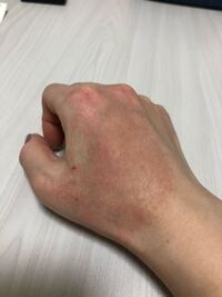 手の甲に赤い湿疹ができて とても乾燥しているし ヒリヒリしています Yahoo 知恵袋