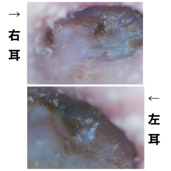 耳の病気 解決済みの質問 Yahoo 知恵袋