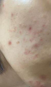 ニキビが治りません 写真のようなニキビがずっとあります しかも右頬だ Yahoo 知恵袋