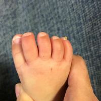 赤ちゃんの足の爪について。 6ヶ月の娘の足の爪（小指）が写真のように飛び出て取れそう（？）になっていて、対処した方が良いのか迷っています。
切ろうにも白いところがなく、どこまで切ったら良いのか…。
本人は至って元気です。

次の検診の際に診せようと思っていますが、もし同じような状態になられた方がいらっしゃったら、対処法やご経験談をお聞かせいただけると嬉しいです。